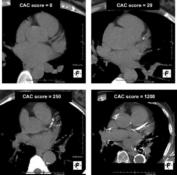 Cardiac calcium scoring CT images