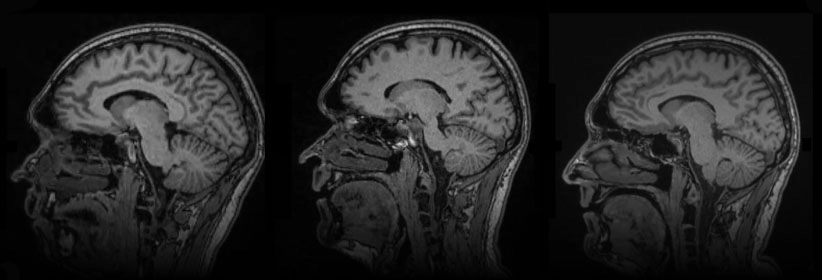 MRI scan