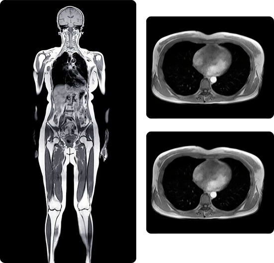 Whole Body MRI